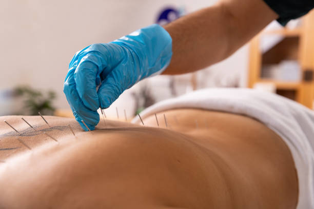 Dry Needling Physical Therapy